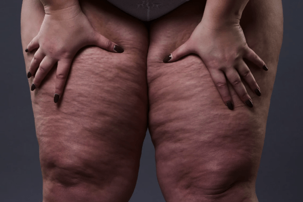 Front view of thighs and knees showing uneven skin texture