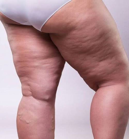 Upper legs showing variations in skin appearance